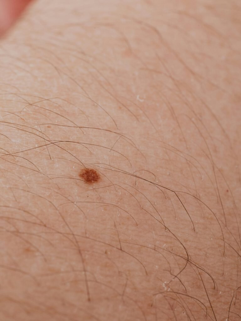Verrugas planas